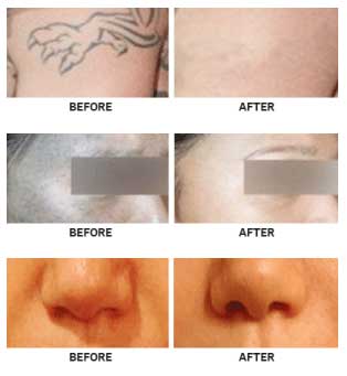 IDS - Tatto Removal Laser Model Q10 Premium